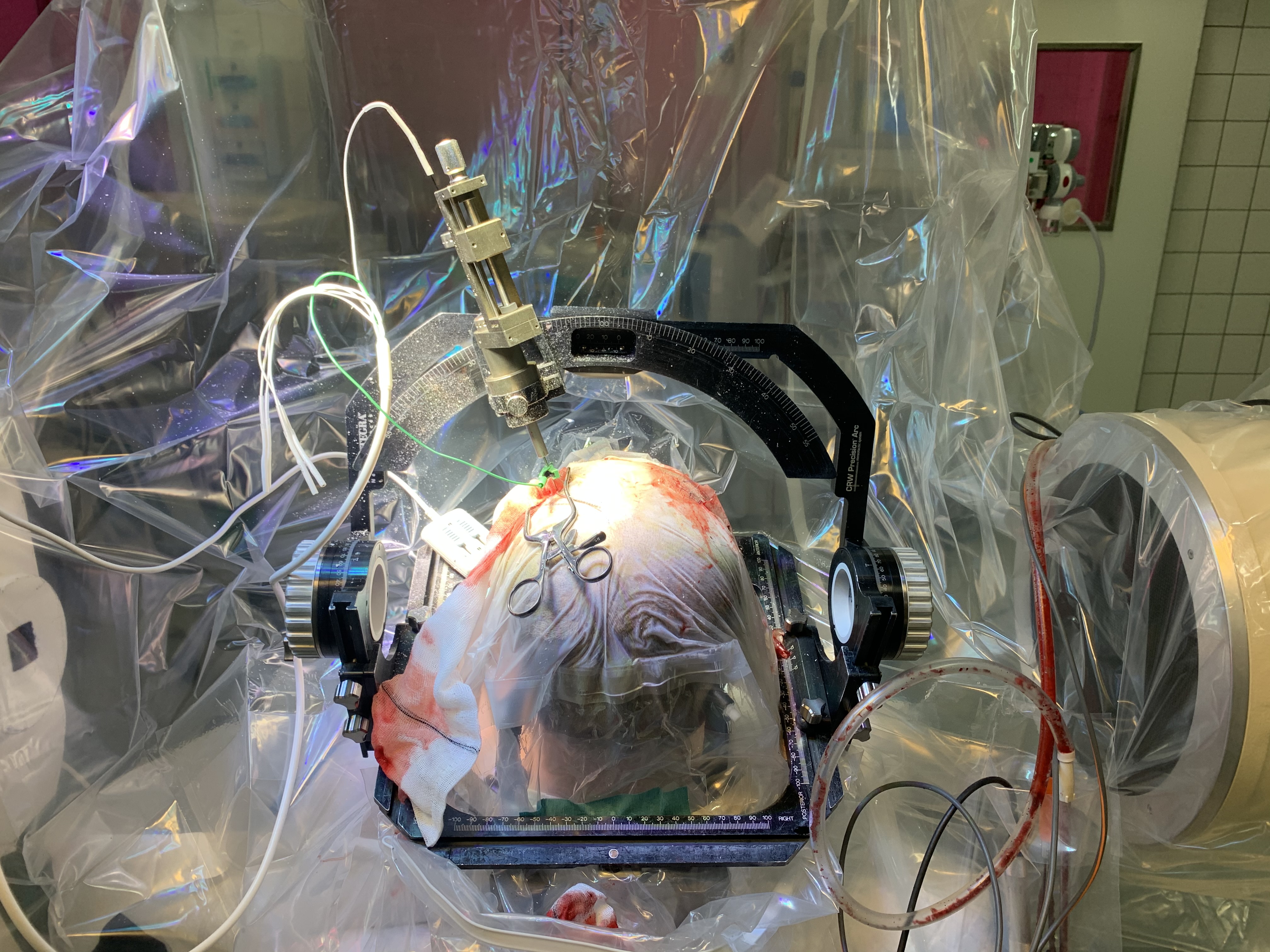 Kirurg Ove Bergdal borer to huller ind til hjernen på den vågne patient, så denne kan give respons på effekten af elektroderne, der skal indsættes.